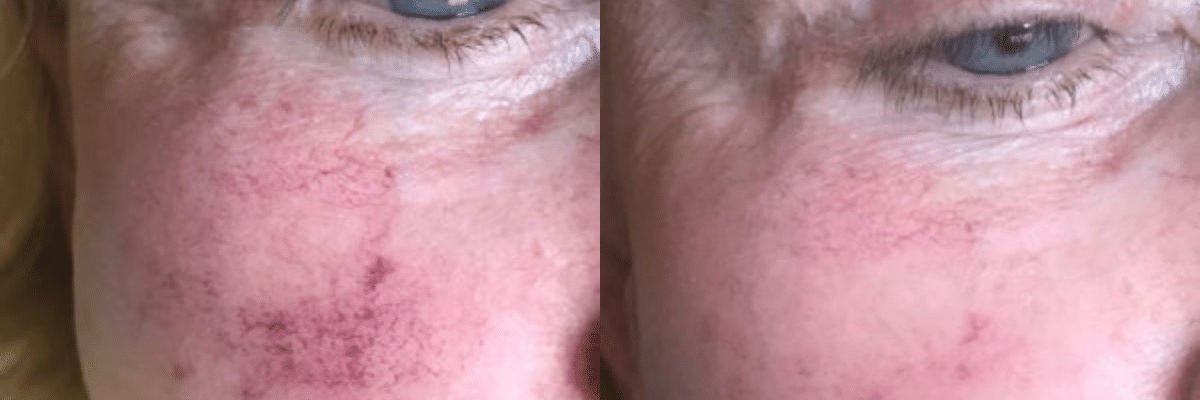 female before and after IPL photofacial treatments for broken blood vessels