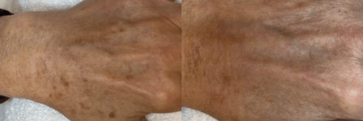 female patient before and after IPL photofacial treatments fro dark spots on hand