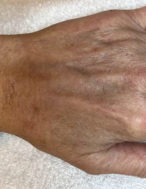 hand 1 month after IPL treatment to remove dark spots