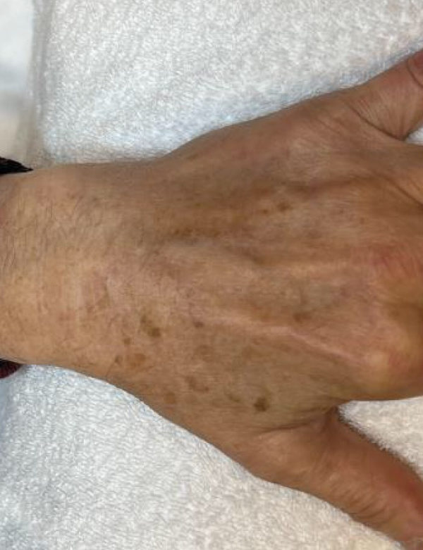 hand with dark spots before IPL treatment