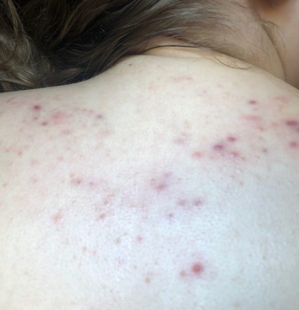 After picture of patient back with Forever Clear BBL Acne Treatment