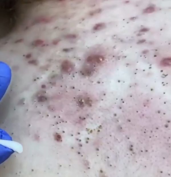 acne on patient back before Forever Clear BBL Acne Treatment