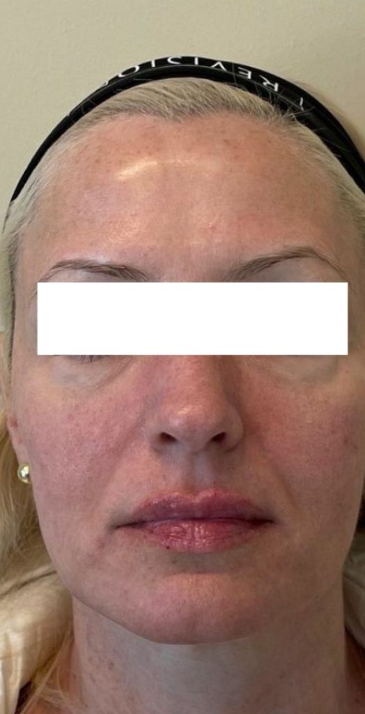 Female lip, jawline, midface Juvederm injections after photo