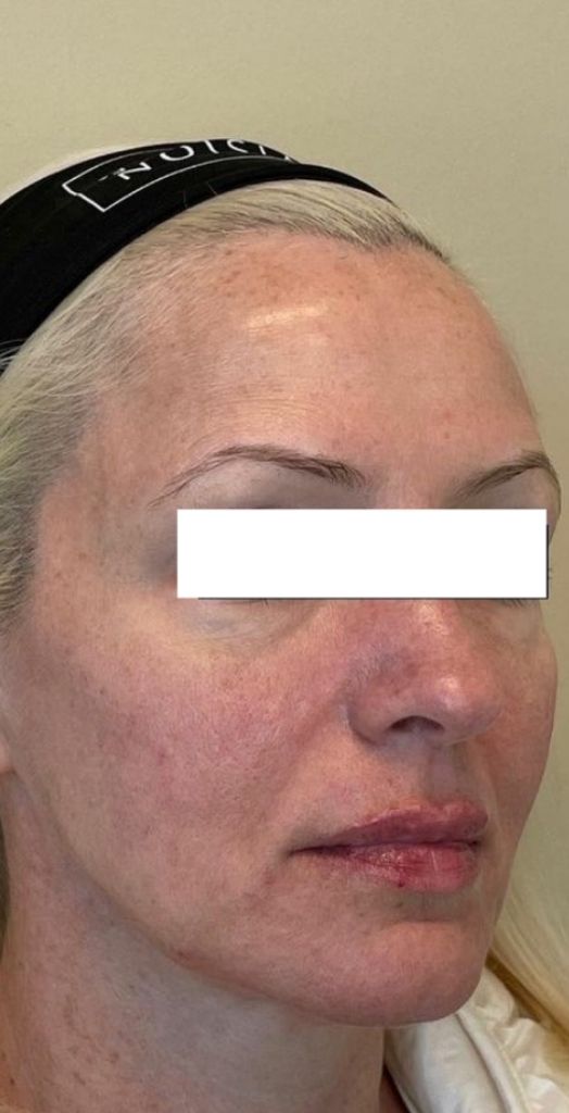 Female lip, jawline, midface Juvederm after photo