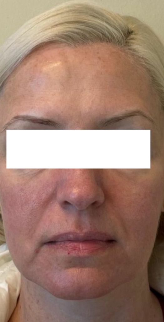 Female lip, jawline, midface Juvederm injection before photo