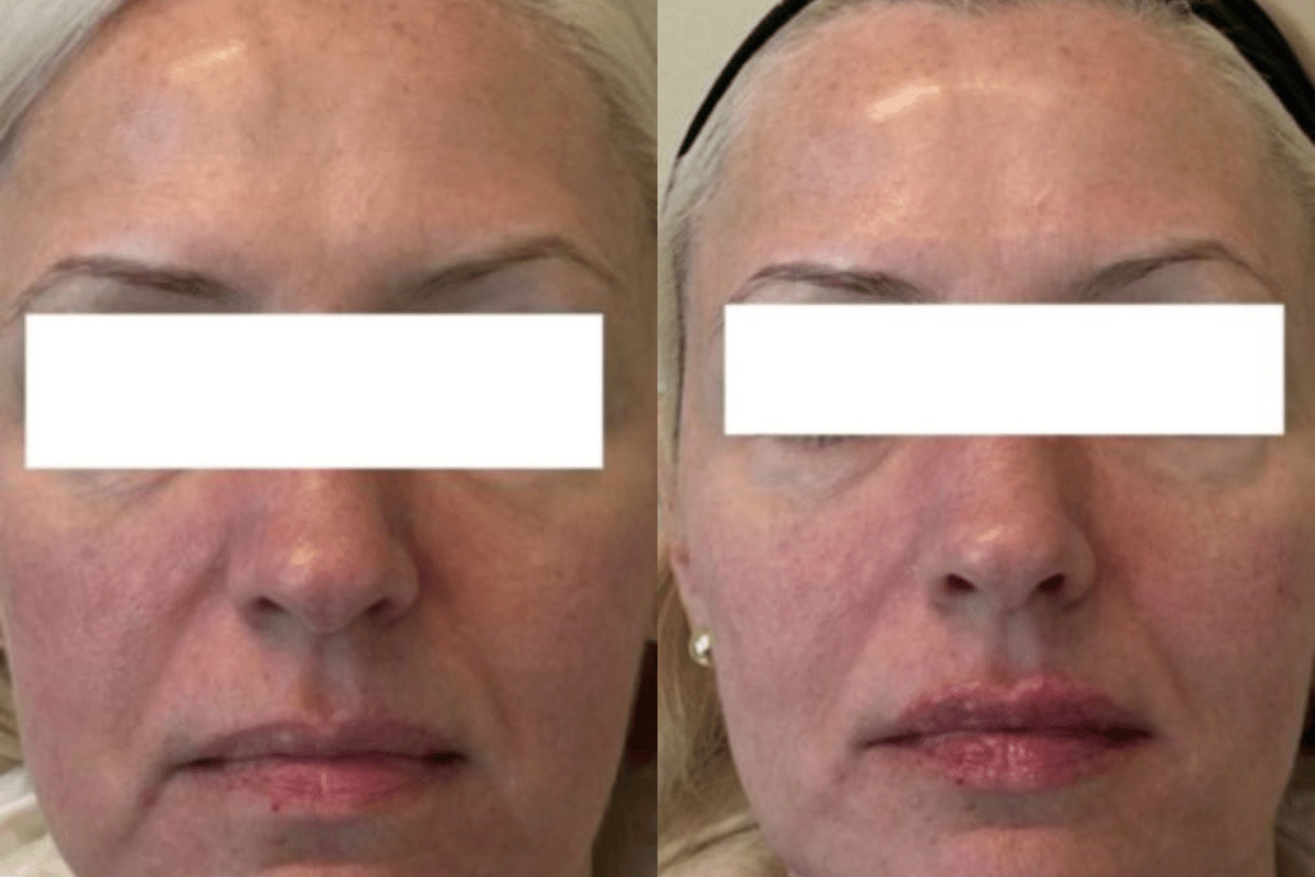 Female lip, jawline, midface Juvederm injections before and after front view photo