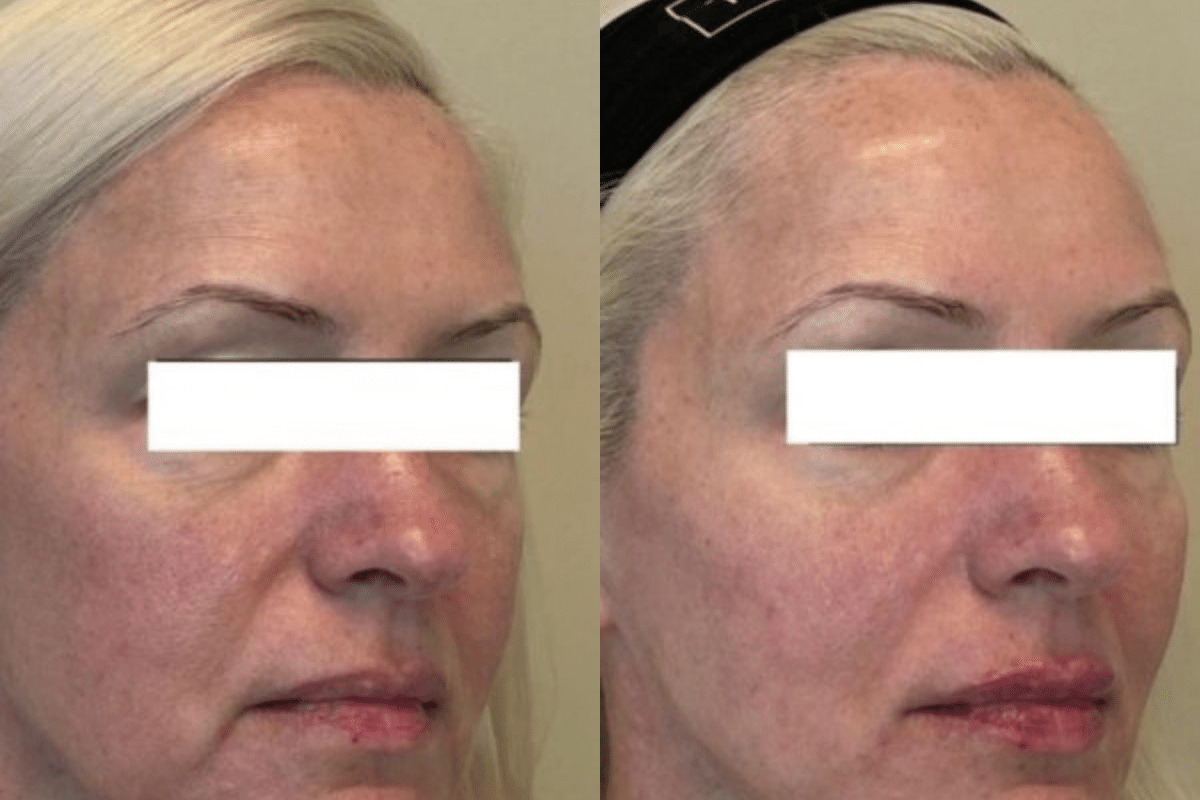 Female lip, jawline, midface Juvederm injections before and after side view photo