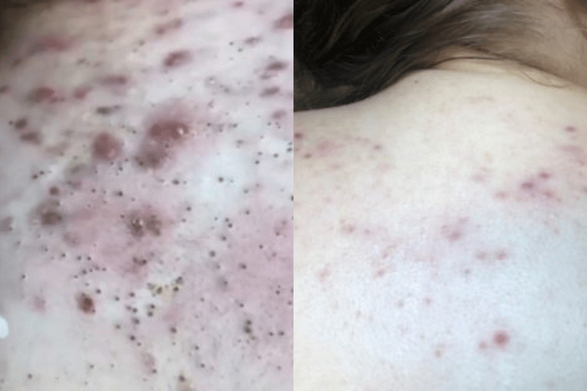 before and after forever clear BBL treatment to treat back acne