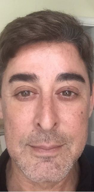 Juvederm Vollure under eye treatment male after