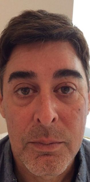 Juvederm Vollure under eye treatment male before