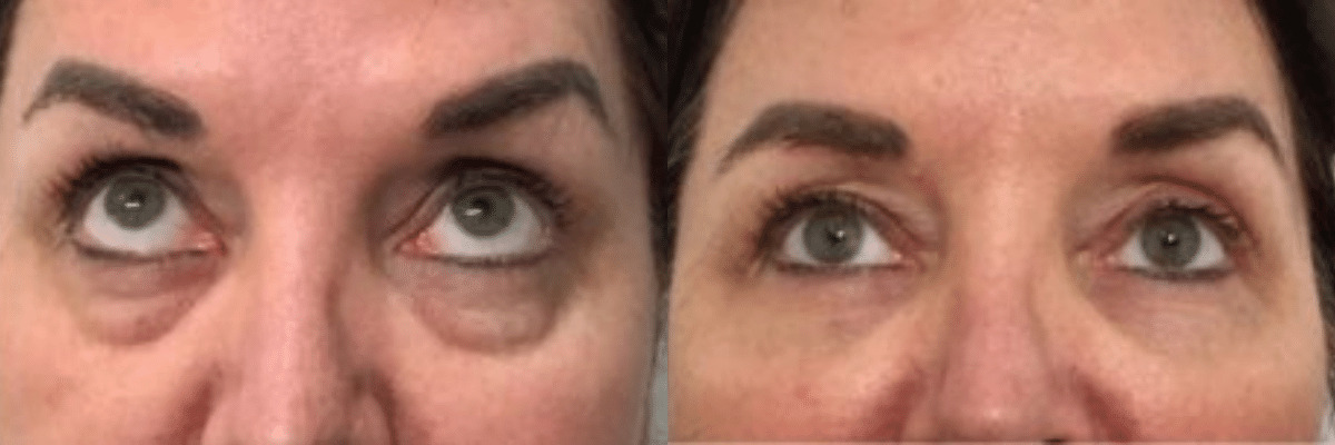 Voluma and Refyne under eye treatment female before and after