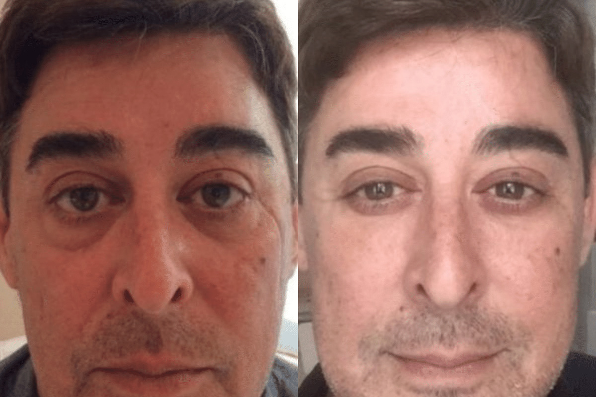 Juvederm Vollure under eye treatment male before and after
