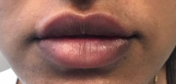 Lips after Vollure filler