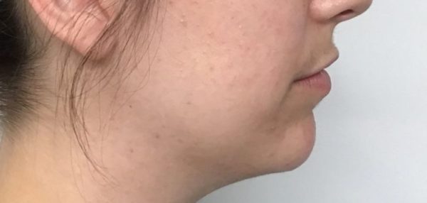 after chin filler female patient