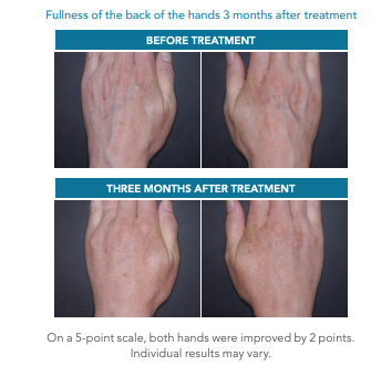 Radiesse before and threee months after hand injections