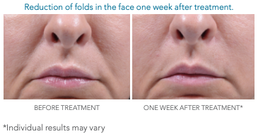 Radiesse lower- face before and one week after injections