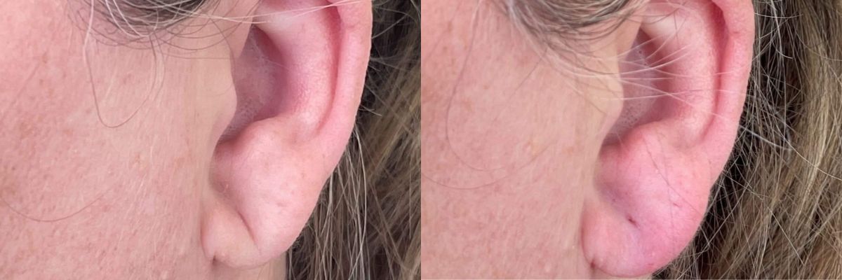 before and after rha4 filler ear lobe correction left side