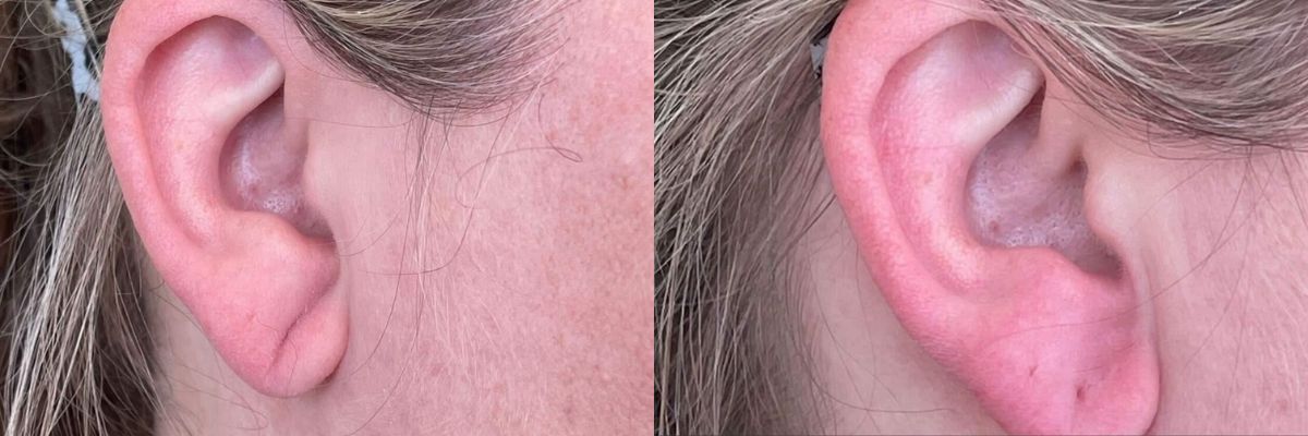 before and after ear lobe correction using RHA4 filler right side