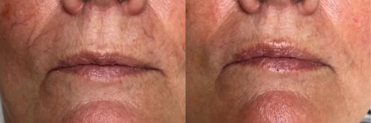 female before after quanta light evo laser treatment broken capillaries