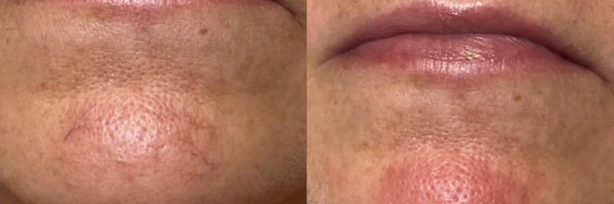 female before after quanta light evo laser treatment broken capillaries chin