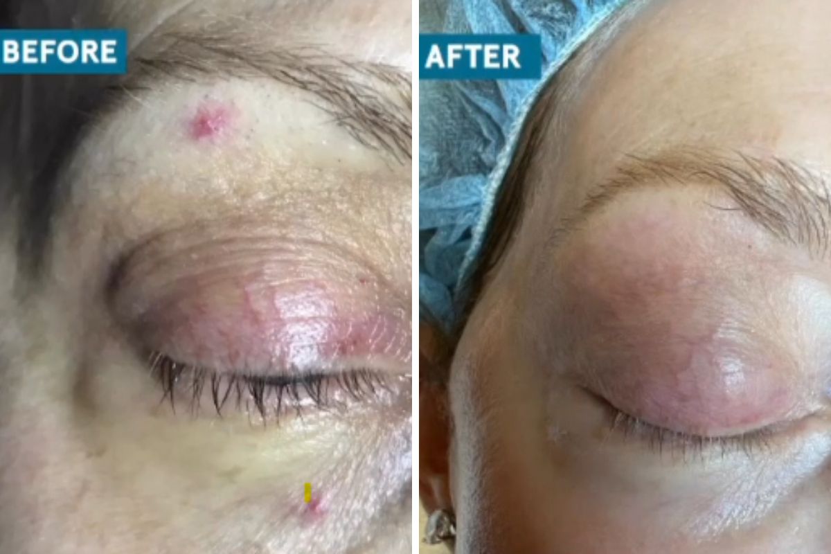 before and after quanta light evo laser cherry angioma over eye treatment