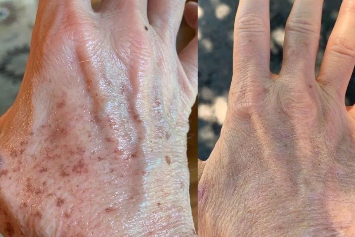 before and after left hand treated for sun damage
