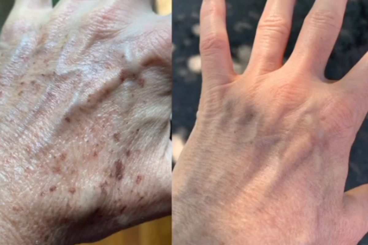 before and after right hand treated for sun damage