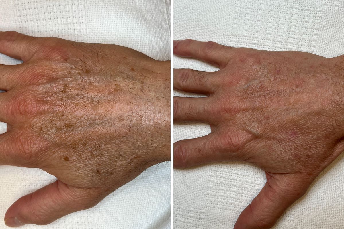 55 year old patient before and after sun damage treatment on right hand