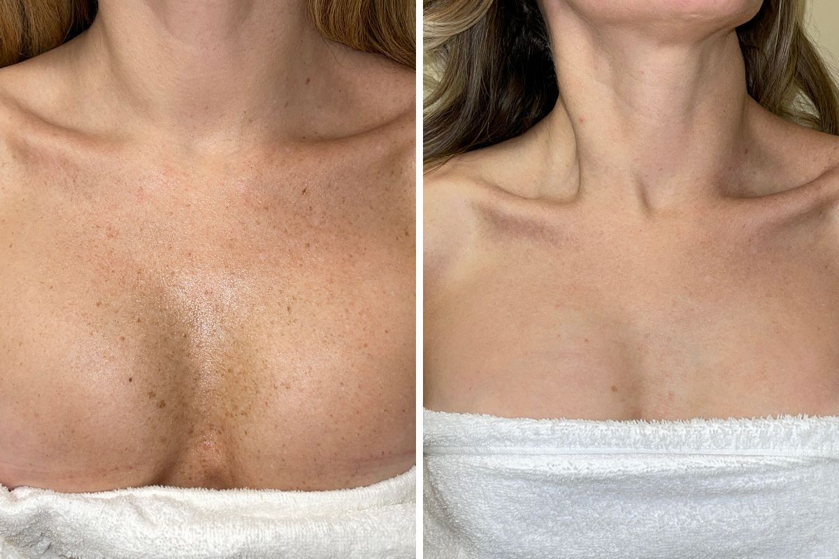 33 year old patient before and after IPL treatment for sun damage on chest