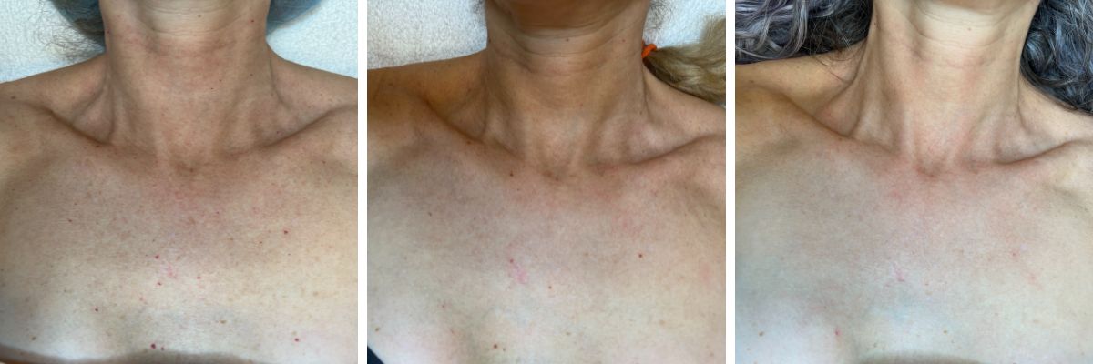 55 year old patient before and after IPL and veinwave treatment for sun damage on chest