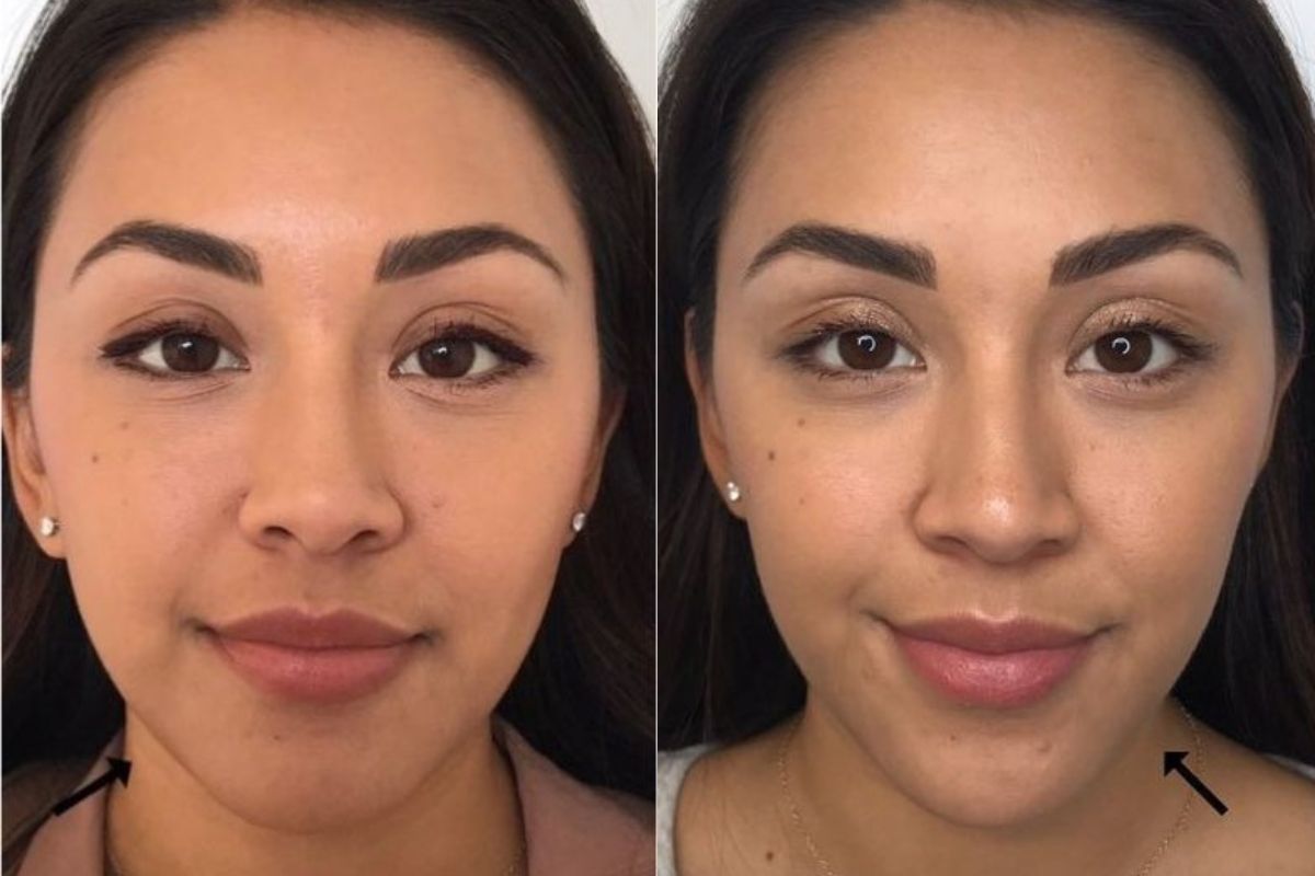 female before and after jawline fillers