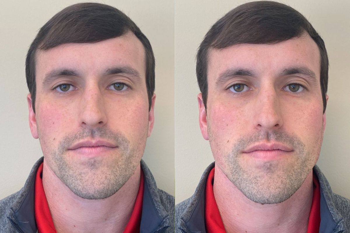 male before and after radiesse jawline and jowl treatment