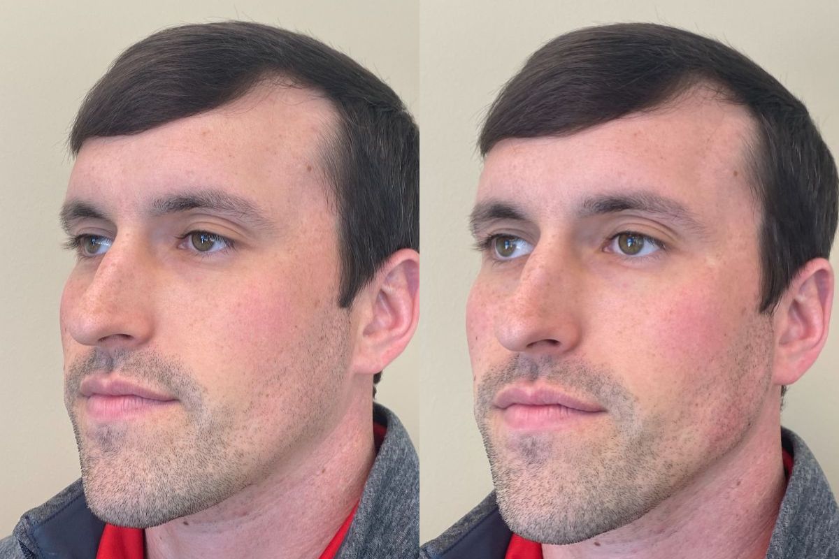 male side view before and after radiesse jawline and jowl treatment