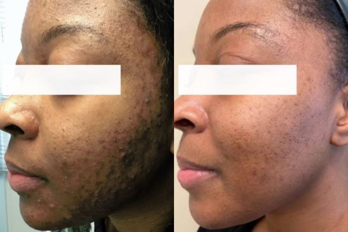 female before after custom adult acne treatment chemical peel