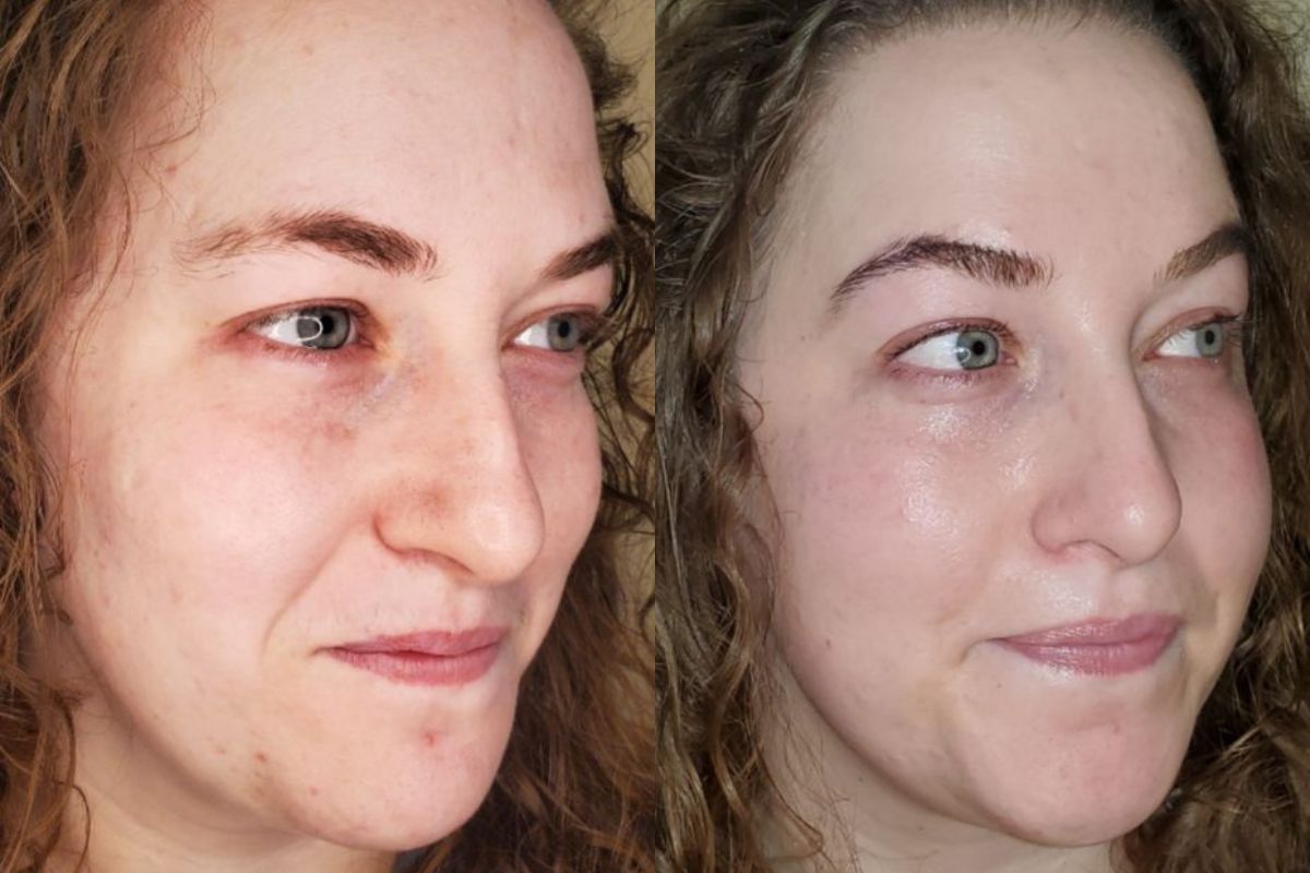 32 year old female before after lactic acid-peel dermaplane treatment