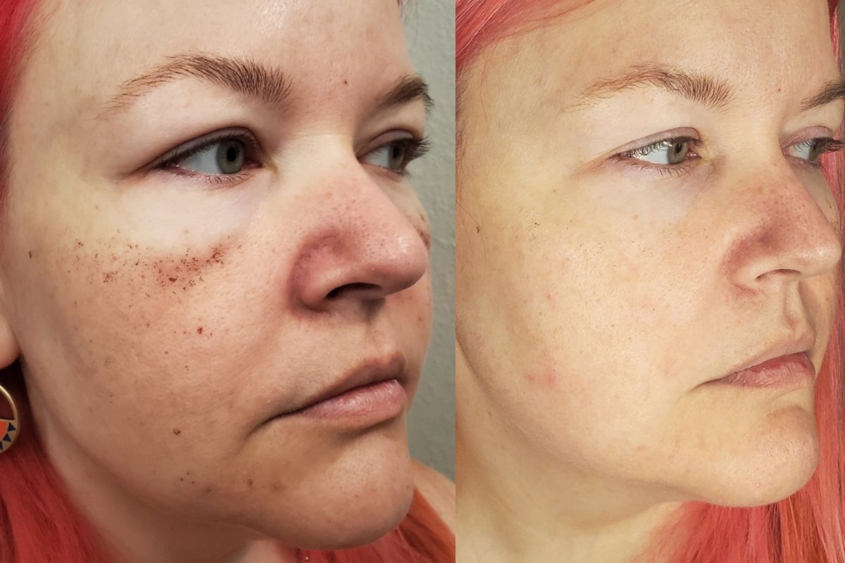 38 year old female before and after BBL laser treatment