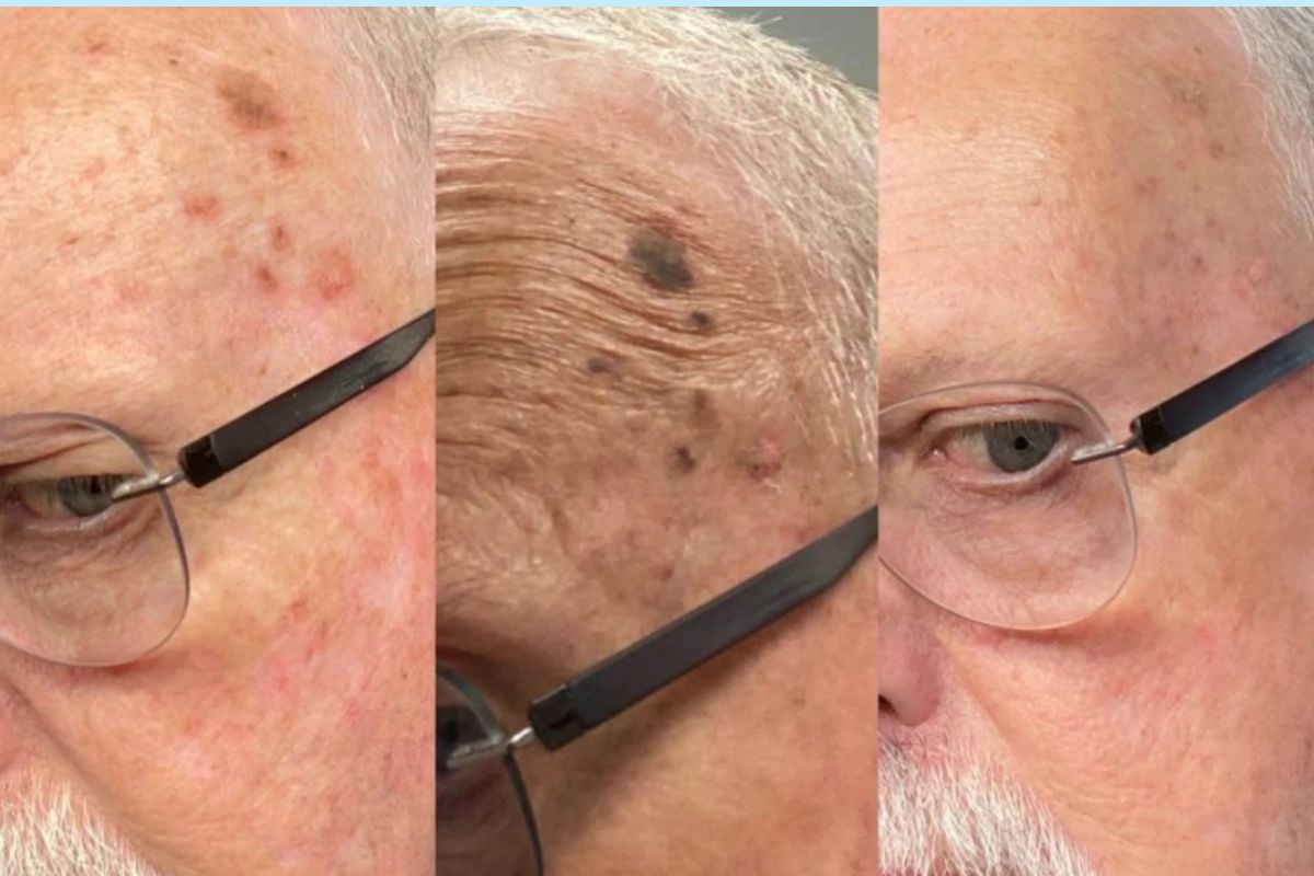 male before and after progression with Quanta Light Evo Laser