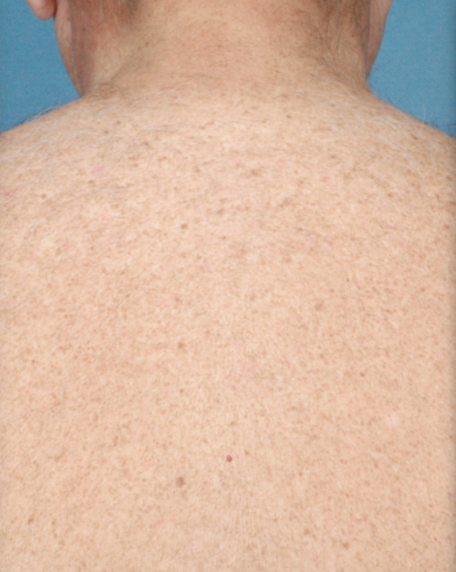 laser hair removal of hair on male back