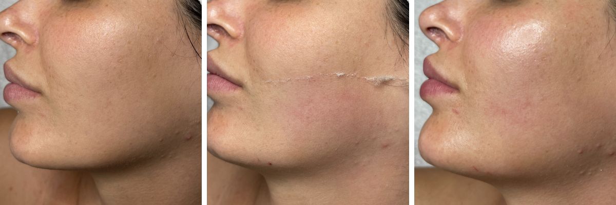 female before during and after dermaplane