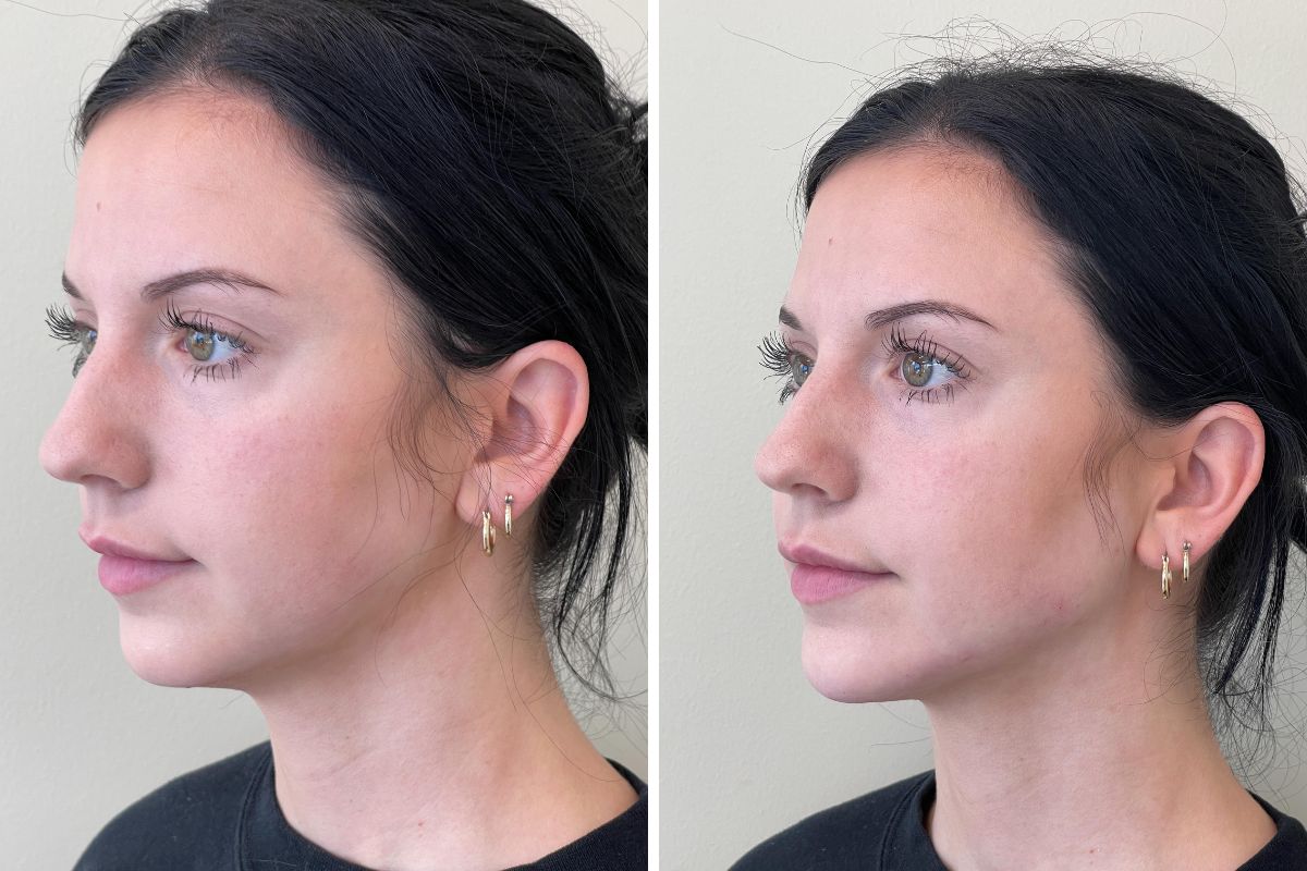 female patient before and after jawline and chin filler treatment