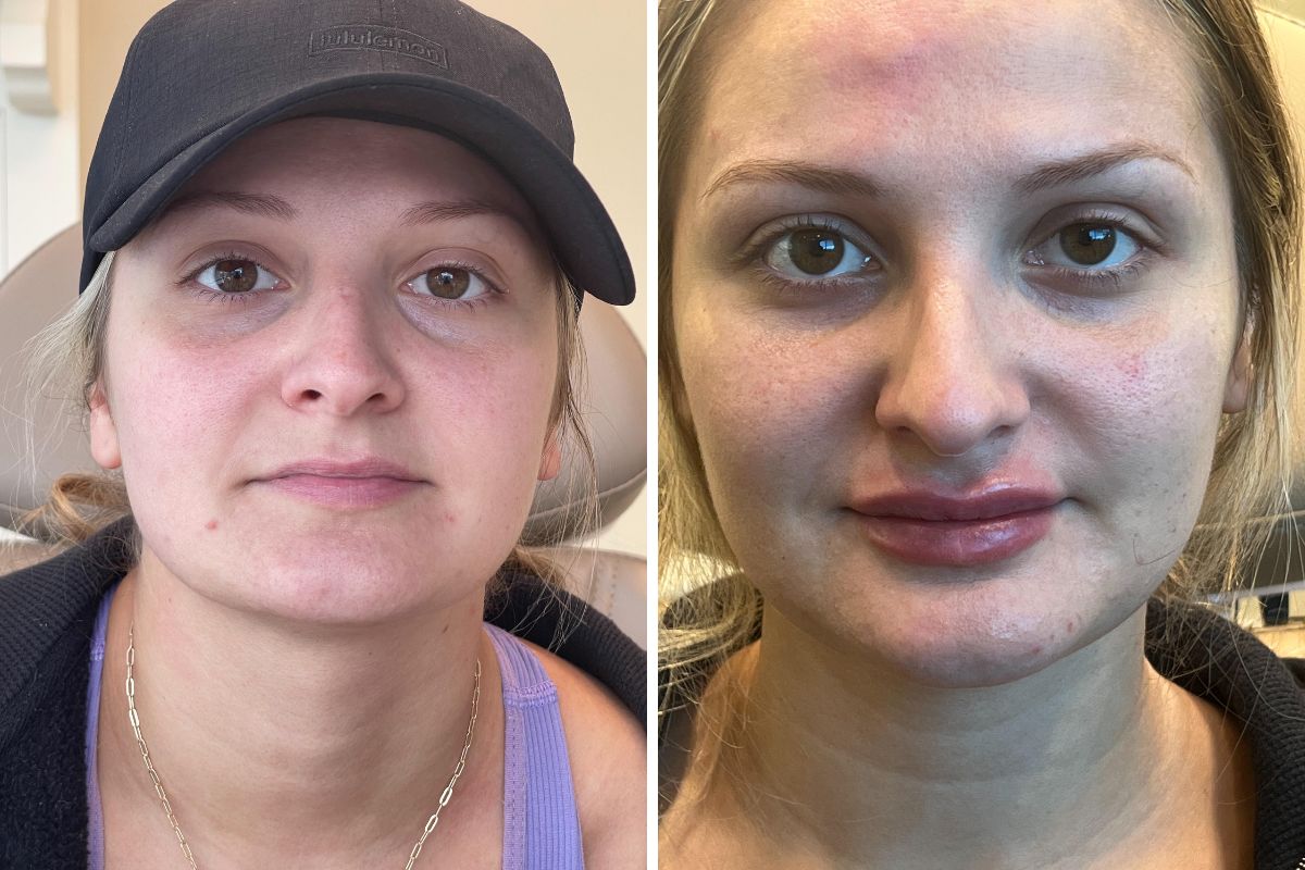 female patient before and after lip filler treatment