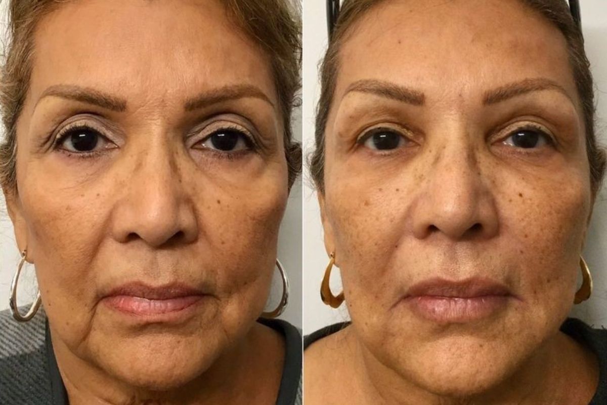 female before and after liquid facelift front view