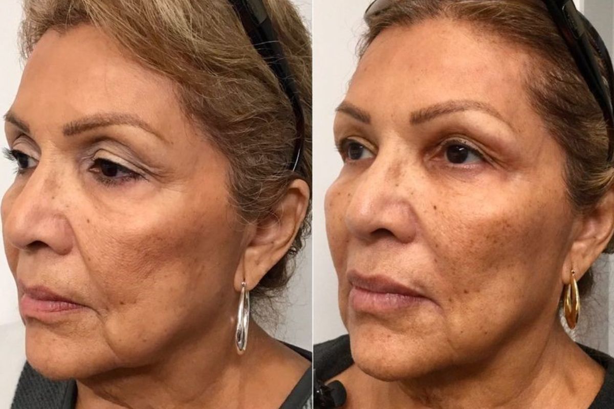 Female sideview before and after liquid facelift