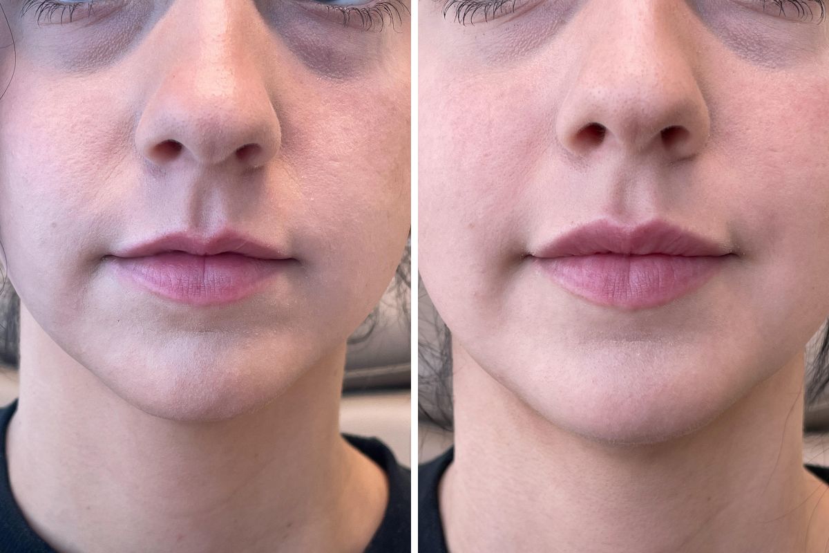 female patient before and after Restylane Kysse lip filler