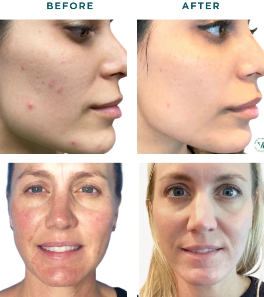 female before and after VI Peel tox booster