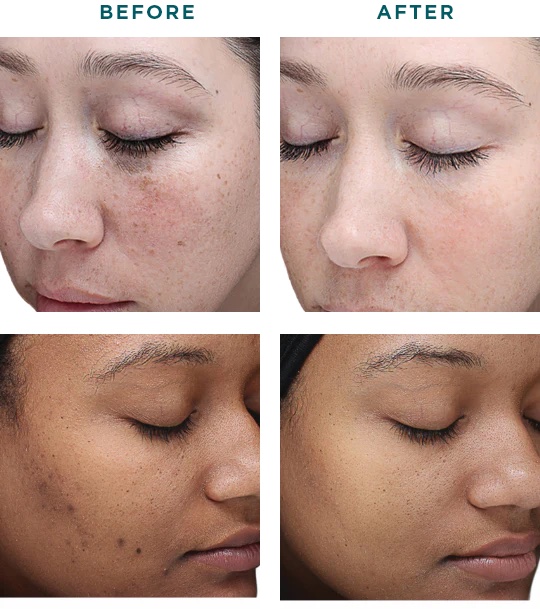 female before and after vi peel original