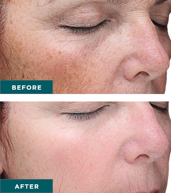 female before and after VI Peel precision plus