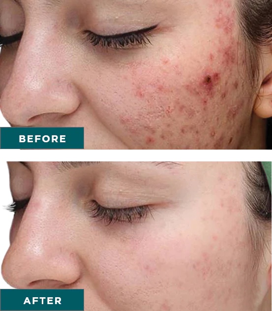 Femal before and after VI Peel purify precision plus
