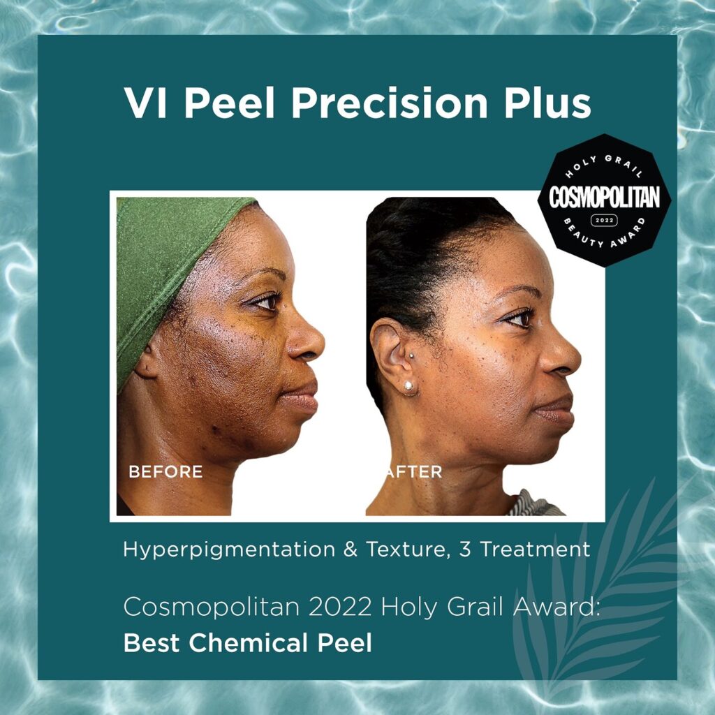 VI Peel precision plus awarded best chemical peel before and after