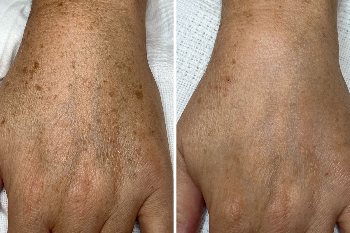 before and after photo of Quanta Light EVO treatment on hands